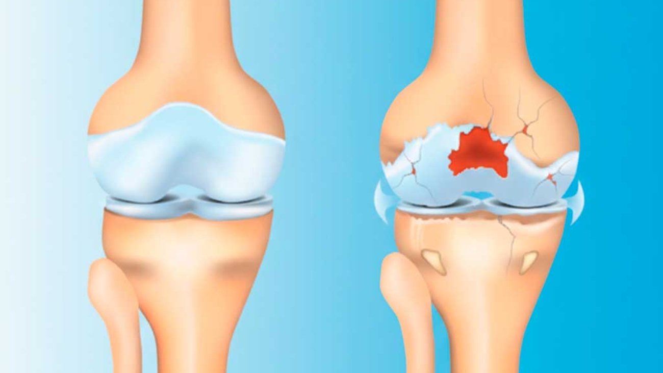 cirurgia-de-ligamento-cruzado-anterior-lca-instituto-trata