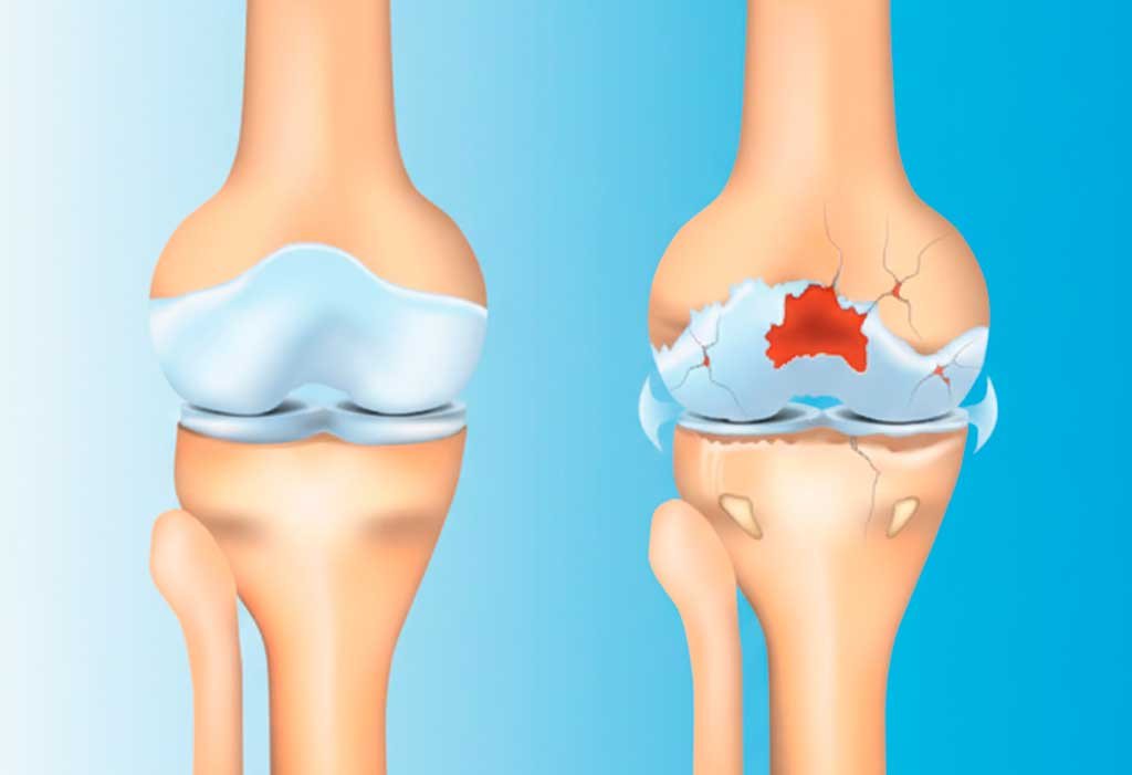 cirurgia-de-ligamento-cruzado-anterior-lca-instituto-trata