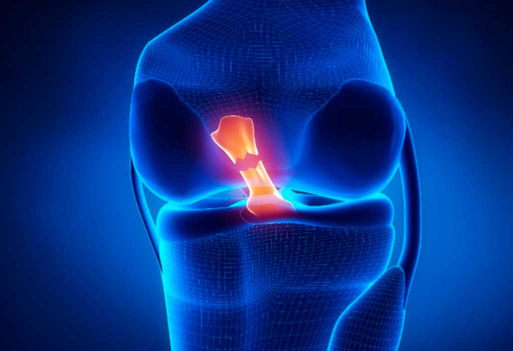 cirurgia-de-ligamento-cruzado-anterior-lca-instituto-trata